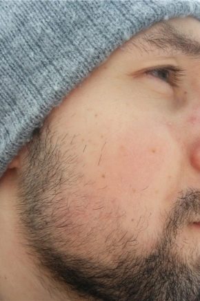 Pourquoi la barbe ne pousse-t-elle pas sur les joues et comment y remédier ?