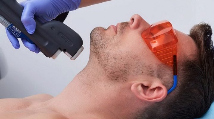 Épilation laser pour hommes